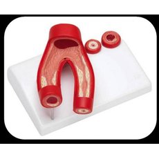 Модель дем. "Здоровые и поврежденные сосуды"