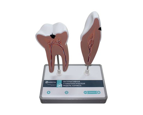 Интерактивная стоматологическая модель кариеса