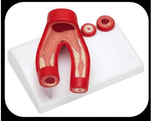 Модель дем. "Здоровые и поврежденные сосуды"