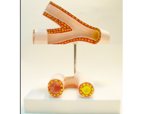 Модель "Здоровые и поврежденные сосуды"